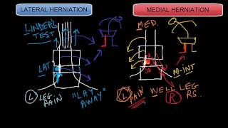 Lateral vs Medial Disc Herniations [upl. by Osborn544]