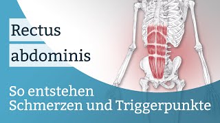 Rectus abdominis Schmerzen Triggerpunkte und deren Aktivierung [upl. by Oihsoy31]