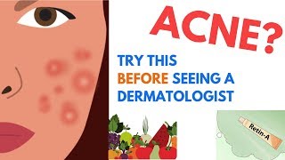 ACNE Treatments  Explained by Dermatologist [upl. by Mercado]