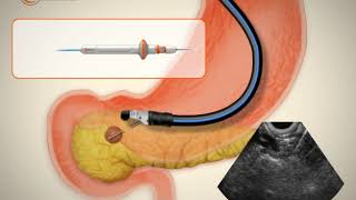 Radiofrecuencia en tumor de páncreas  EUSRA con endosonógrafo [upl. by Hnib708]