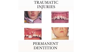 INJURIES TO PERMANENT DENTITION  PAEDIATRIC DENTISTRY  FINAL YEAR [upl. by Pattin]