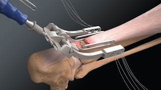 Whats New Top Video Achilles Midsubstance SpeedBridge™ Implant System [upl. by Coshow867]