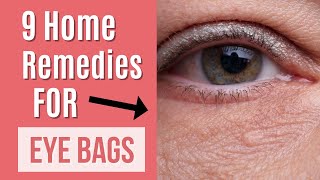 9 Home Remedies For Eye Bags  Quick Fix [upl. by Hareema]