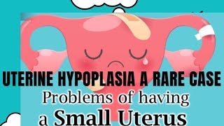 Uterine Hyoplasia A rare case🔙🔙🔙 [upl. by Asik]