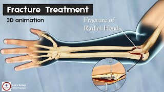 Fracture of the Radial head  3D animation [upl. by Alurd254]