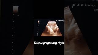 ectopic pregnancy Rt adnexal ring sign [upl. by Aielam625]