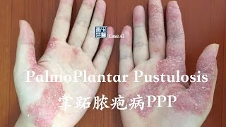 how to treat palmoplantar pustulosis psoriasis 掌跖脓疱病 PPP [upl. by Enomas231]