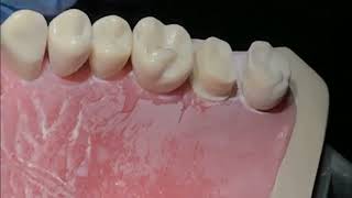 PFM occlusal reduction ADC exam [upl. by Sito]