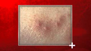 Signs of Bed Bug Bites  Health Checks [upl. by Lark]