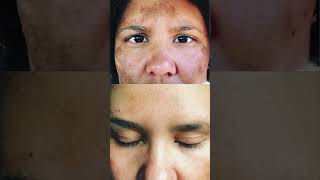 The Best Dark Spots Treatment [upl. by Evante983]