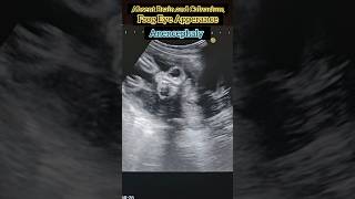 Anomaly Scan  Anencephaly  Major Anomaly 💔 medical anomaly ultrasound pregnancy shorts [upl. by Atirys]