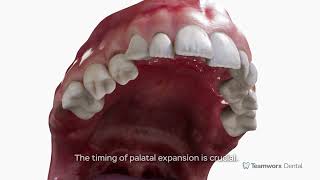 Palatal Expansion [upl. by Apple657]