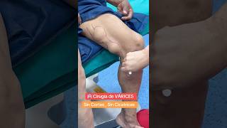 🏩 Cirugía de varices varicosevein ☺️🤝 Radiofrecuencia Sin Cortes 😃📲593995178395 [upl. by Elleirbag]