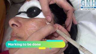 Treatment of Melasma amp Hyperpigmentation at GNH Hospital Gurgaon [upl. by Alegnatal307]