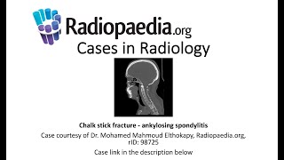 Chalk stick fracture  ankylosing spondylitis Radiopaediaorg Cases in Radiology [upl. by Ynohta]