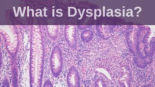 What is Dysplasia  Pathology mini tutorial [upl. by Ylluz]