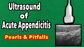 Ultrasound of Acute Appendicitis Pearls and Pitfalls [upl. by Asillem]