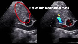 SVC syndrome diagnosis by echocardiography [upl. by Chemar]