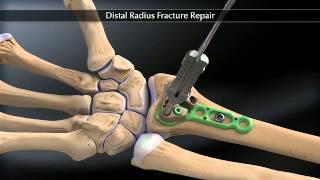 Arthrex Distal Radius Fracture Fixation [upl. by Cesar193]