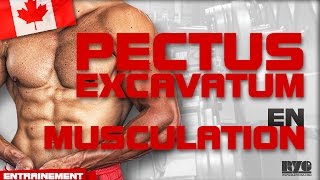 LE PECTUS EXCAVATUM EN MUSCULATION [upl. by Okorih]