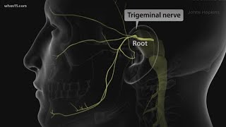 Trigeminal Neuralgia local doctors may have found the cure [upl. by Bennink996]