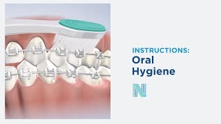 Oral Hygiene Care Instructions in Fresno CA  Nalchajian Orthodontics [upl. by Allrud645]