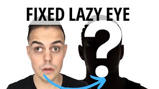 Lazy Eye Fixed amblyopia strabismus [upl. by Munford689]