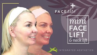 Mini facelift and neck lift using Inmode facetite device [upl. by Anneliese303]