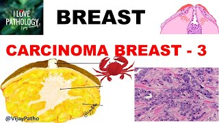 Carcinoma in situ [upl. by Simsar]