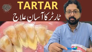 How to Remove TARTAR from Teeth at Home Naturally [upl. by Cleve]