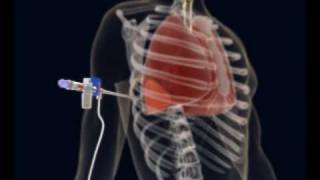 How to make a Thoracentesis pleural puncture with Pleurasafe [upl. by Ahrendt]