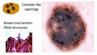 Seborrheic keratosis and solar lentigo  Dr Cristian NAVARRETEDECHENT [upl. by Nosnor862]