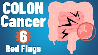 Colon cancer 6 EARLY symptoms amp why they occur  Colon cancer symptoms  colorectal cancer [upl. by Pathe]