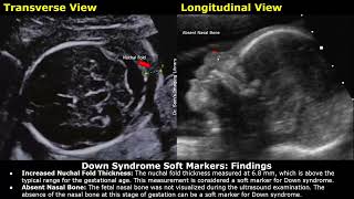 Down Syndrome Soft Markers Fetal Ultrasound Report Example  Trisomy 21 Aneuploidy Obstetric USG [upl. by Parshall]