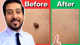 How to Remove Skin Tags Yourself AT HOME  Get Rid of Skin Tags NOW [upl. by Nawuj]