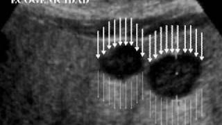 01 Ecografía Hepatobiliopancreática Fundamentos Básicos [upl. by Ethbinium]