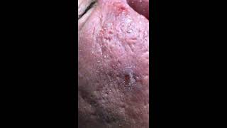 Acne inflammation perennialfiber like noodles  official video [upl. by Bhatt279]