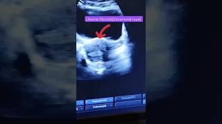 Uterine fibroidsultrasound imagesfibroidsintramural typeytshortshortvideo [upl. by Hael]