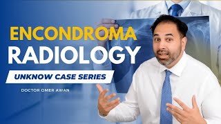 The Radiology of Enchondroma  A Comprehensive Guide for Medical Students  Dr omer awan [upl. by Ced]