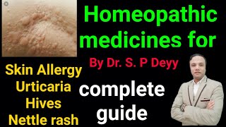 Homeopathy medicines for skin allergy  urticaria  nettel rash  itching  skin problems [upl. by Earb537]