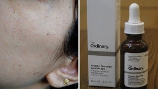 Ascorbyl Glucoside 12I applied this product for 30 days and this happened  Review  BeautywdBrain [upl. by Nowed827]