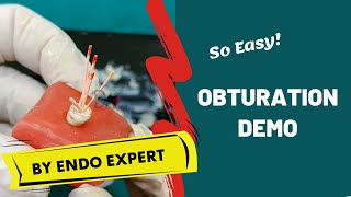 Obturation Made Easy ENDODONTICS DEMO [upl. by Gagne]