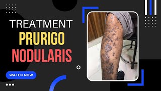 Prurigo Nodular Eczema Treatment ITCHY Skin bump एक्जिमा इलाज Dr Uttam Lenka [upl. by Carew740]