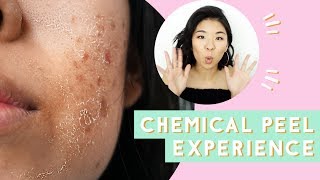 ✂ Chemical Peel for Acne amp Scars Before amp After [upl. by Aneet171]