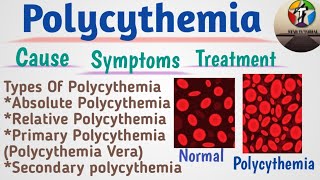 Polycythemia In Hindi ll Polycythemia Vera ll Hematology And Blood Banking [upl. by Mackey]