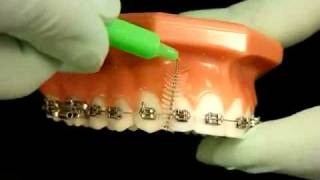 Bracesquestionscom  Brushing With Braces How to Brush Teeth [upl. by Engracia]