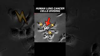 Human lung cancer cells dividing RAPIDLY microscope cancer biology oncology medical science [upl. by Lebatsirc]