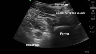 LSORA US guided Popliteal Sciatic Regional Anaesthesia block [upl. by Weinshienk632]