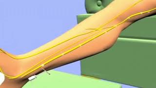 Heres how percutaneous tibial nerve stimulation PTNS provides relief from overactive bladder [upl. by Moishe]