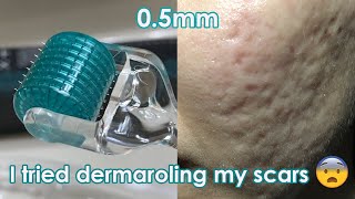 I tried dermarolling my ACNE SCARS  Demo  Review [upl. by Gilder]